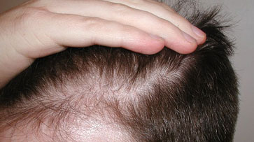fue hair transplant training in india