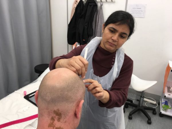 scalp micro-pigmentation in india