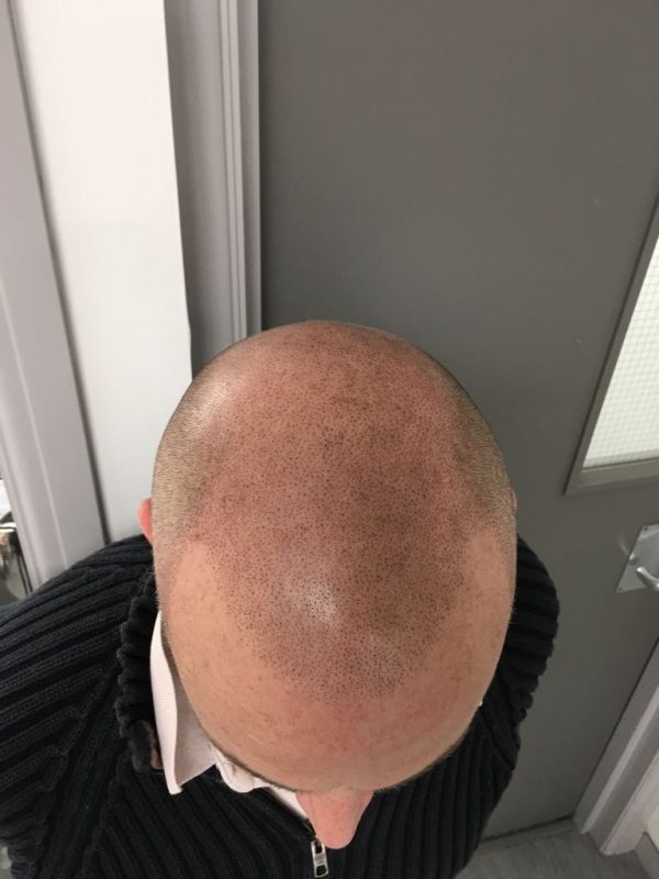 scalp micro-pigmentation