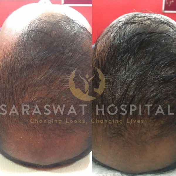 scalp micro-pigmentation training courses in india