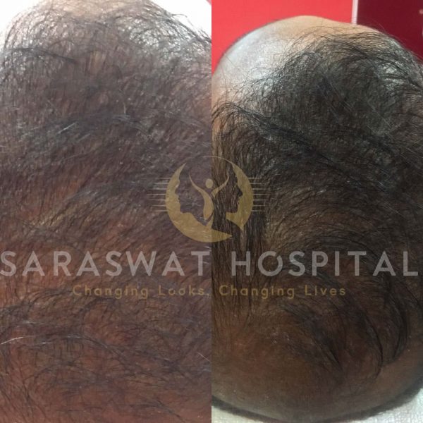 scalp micro-pigmentation training courses