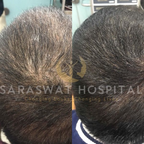 scalp micro-pigmentation training courses