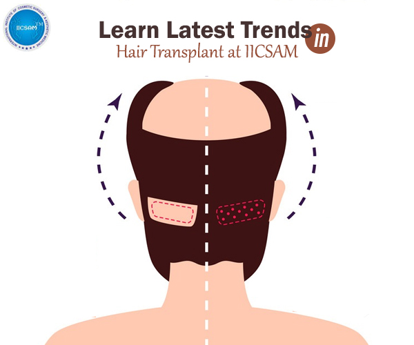 Latest Trends in Hair Transplant