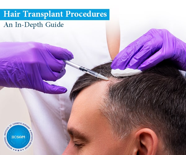 An In-Depth Guide to Hair Transplant Procedures | IICSAM An In-Depth Guide to Hair Transplant Procedures | IICSAM