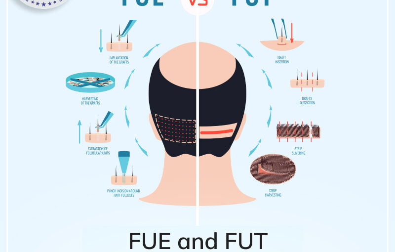 Hair Transplant Training Course Understanding FUE and FUT