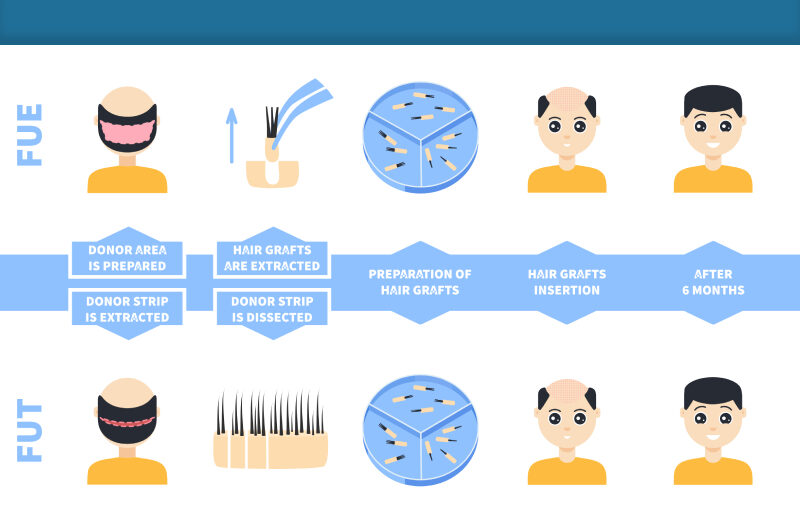 Decode the Difference Between FUT & FUE Hair Transplant Training